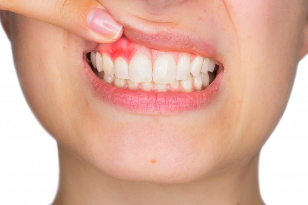 آیا در صورت ابتلا به بیماری لثه دندان های خود را از دست خواهید داد؟