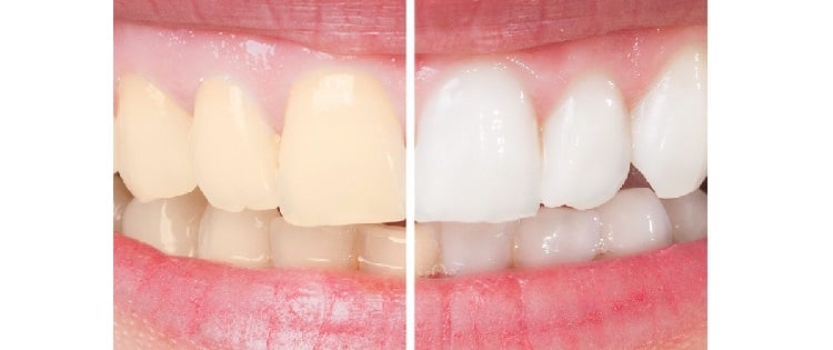 سفیدکردن-دندان