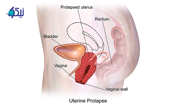 افتادگی رحم