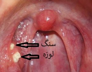 سنگ-لوزه
